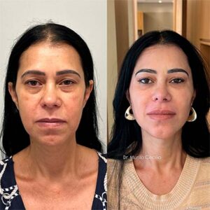 ANTES E DEPOIS 2@1,25x