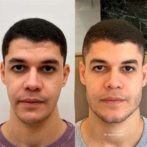 ANTES E DEPOIS 3@1,25x