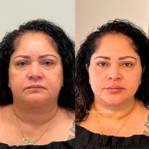 ANTES E DEPOIS - FEED@1,25x